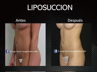 Antes y después liposucción