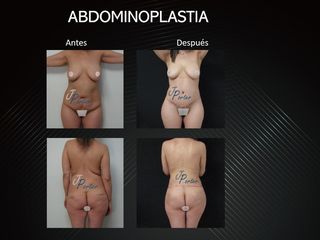 Antes y después Abdominoplastia