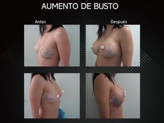 Antes y después Aumento de busto