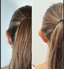 Otoplatia - Dr. Pavel Carrillo Alvarado