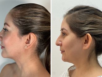 Rinoplastia antes y después - 877412