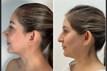 Rinoplastia + Otoplastia - Dr. Pavel Carrillo Alvarado