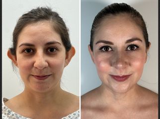 Rinoplastia + Otoplastia - Dr. Pavel Carrillo Alvarado