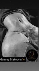 Mommy Makeover - Dr. Pavel Carrillo Alvarado