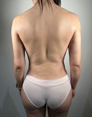 Liposucción - Dr. Pavel Carrillo Alvarado
