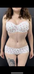 Abdominoplastia - Dr. Pavel Carrillo Alvarado