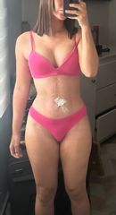 Lipoabdominoplastia -Dr. Pavel Carrillo Alvarado