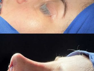 Rinoplastia antes y después - 877420