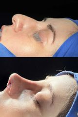 Rinoplastia - Dr. Pavel Carrillo Alvarado