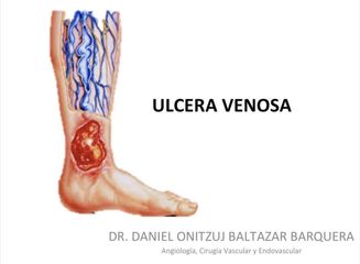 Ulcera venosa