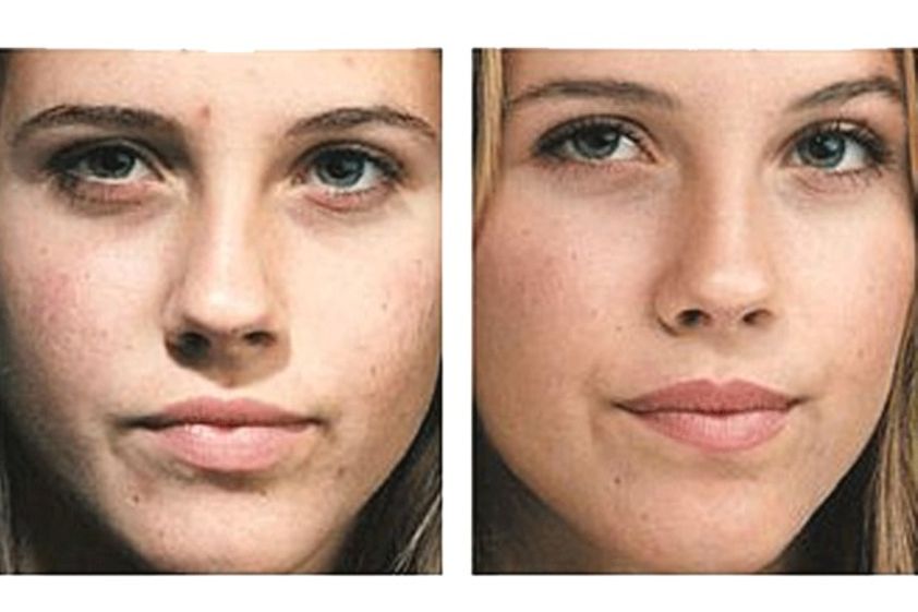Microdermoabrasión antes y después - 501889