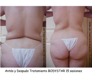 Antes y después Lipoescultura