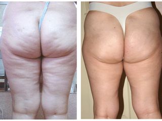 Antes y después Tratamientos anticelulíticos