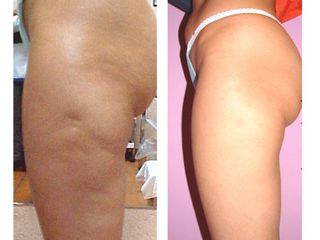 Antes y después Tratamientos anticelulíticos