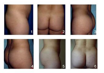 Antes y después de Gluteoplastia