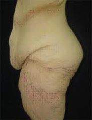Antes y después de Liposucción