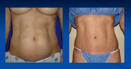 Antes y después de  Abdominoplastía