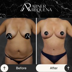 Mommy makeover - Dr. Abner Requena