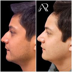 Rinoplastia - Dr. Abner Requena