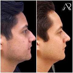 Rinoplastia - Dr. Abner Requena