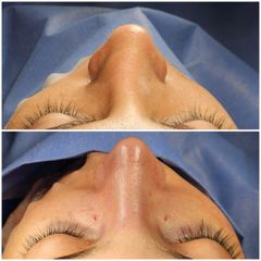 Rinoplastia - Dr. Abner Requena