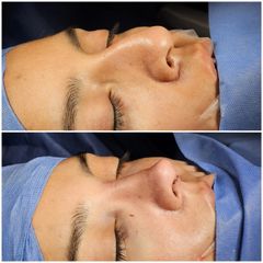 Rinoplastia - Dr. Abner Requena