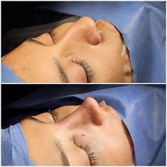 Rinoplastia - Dr. Abner Requena