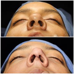 Rinoplastia - Dr. Abner Requena