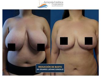 Reducción de mamas - 634644
