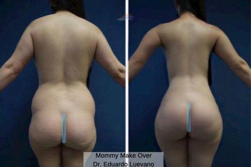 Mommy makeover antes y después - 647447