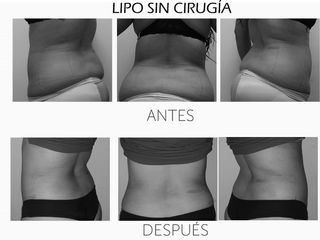 Antes y después de Lipo Sin Cirugía 