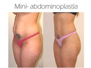 Antes y después de Mini-Abdominoplastía
