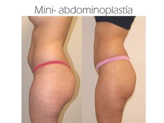 Antes y después de Mini-Abdominoplastía