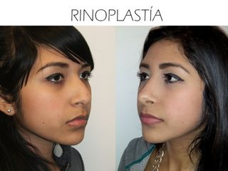 Antes y después de Rinoplastía