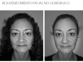 Antes y después de Rejuvenecimiento Facial