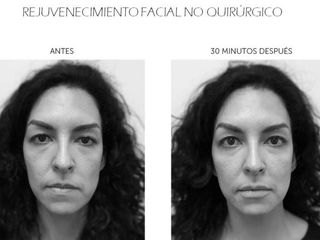 Antes y después de Rejuvenecimiento facial