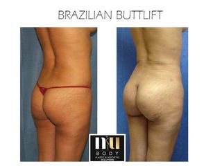 Antes y después de Brazilian Butt Lift