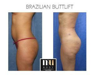 Antes y después de Brazilian Butt Lift 