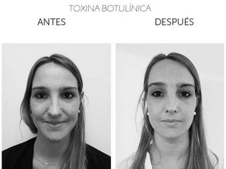 Antes y después de Toxina Botulínica