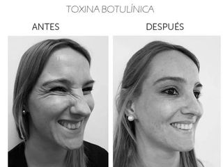 Antes y después de Toxina Botulínica 