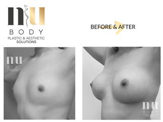  Antes y después de Aumento de busto
