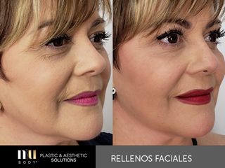 Antes y después de Rellenos Faciales y toxina botulínica