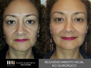 Antes y después de Rejuvenecimiento Facial sin cirugía (toxina botulínica, relleno)