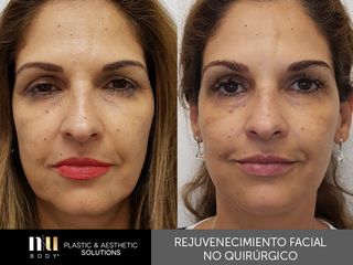 Antes y después de Rejuvenecimiento Facial sin cirugía (toxina botulínica, relleno, dermapen e IPL.)