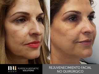 Antes y después de Rejuvenecimiento Facial sin cirugía (toxina botulínica, relleno, dermapen e IPL.)