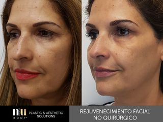 Antes y después de Rejuvenecimiento Facial sin cirugía (toxina botulínica, relleno, dermapen e IPL.)