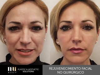 Antes y después de Rejuvenecimiento Facial sin cirugía (toxina botulínica, relleno, dermapen e IPL.)