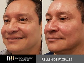 Antes y después de Rejuvenecimiento Facial sin cirugía (toxina botulínica, relleno, dermapen e IPL.)