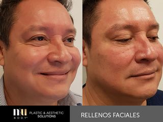 Antes y después de Rejuvenecimiento Facial sin cirugía (toxina botulínica, relleno, dermapen e IPL.)