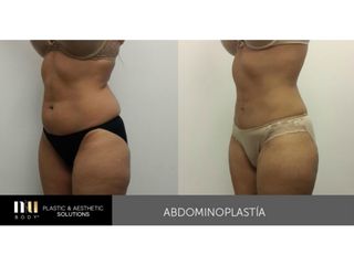 Antes y después de Abdominoplastia